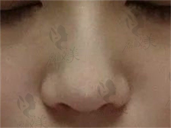 梁晓健做鼻子风格很自然，术后我拥有了自然感妈生鼻也太值了吧