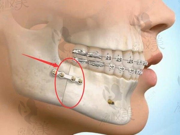 何锦泉博士的3D导板正颌术太神奇，丑了20多年的我终于敢摘下口罩了