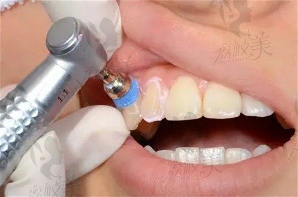 洗牙中喷砂和抛光的作用是什么