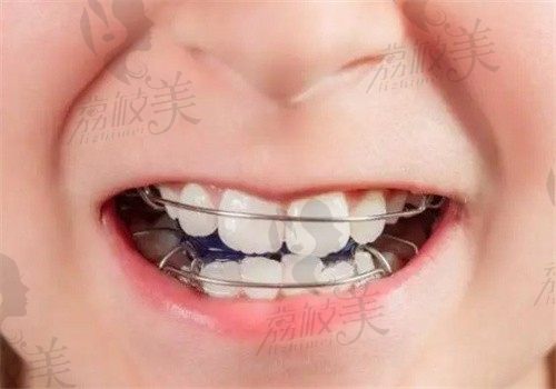 儿童早期牙齿干预矫正有必要吗？