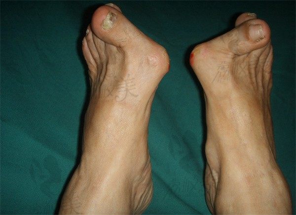 大脚骨手术后多久能下地走路？ 