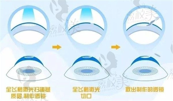 近视手术和干眼是否有冲突？手术后是否会引发干眼？