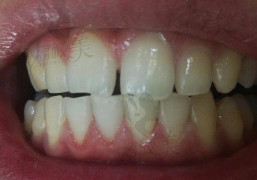 牙缝大可以用什么办法修复啊？