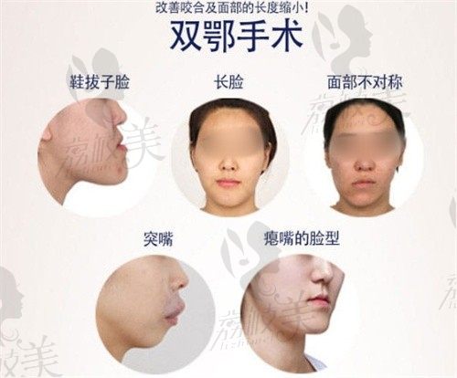 韩国Faceline整形外科做双鄂手术绝了,改善了我的咬合和脸型