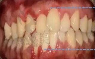 种植牙后牙龈萎缩现象很普遍吗？种植牙牙龈萎缩露出基台怎么办？