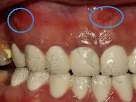 根管治疗中出现瘘管怎么办?牙龈瘘管医生建议不治疗?