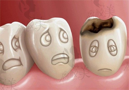 根管治疗后必须做牙冠吗？
