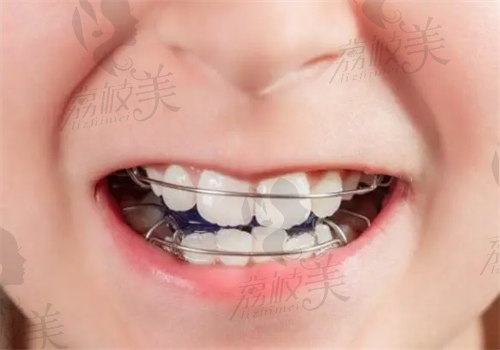 儿童牙齿矫正需要拔牙,后期有影响吗？