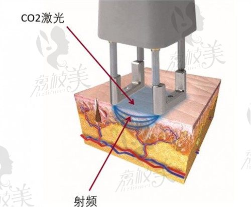 srt100疤痕放疗是骗局吗？