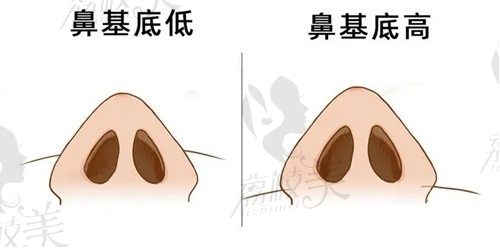 鼻基底填充用什么材料比较好？膨体vs玻尿酸前后对比给你答案