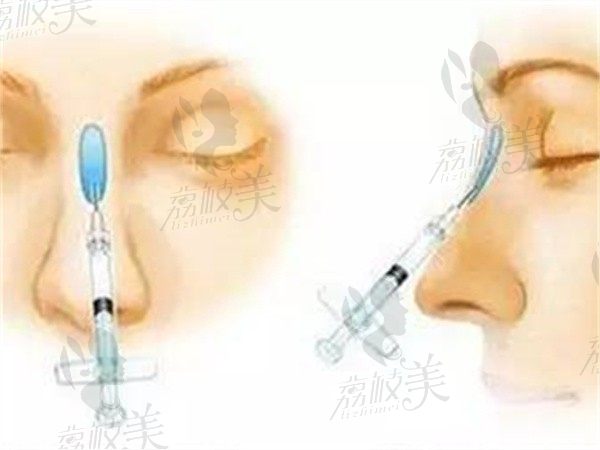 在四川米兰柏羽医学美容医院进行了注射隆鼻，不动刀就有小翘鼻很快乐