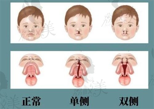 找赵绛波医生做唇颚裂二次手术确实放心,轻松还给孩子健全容貌