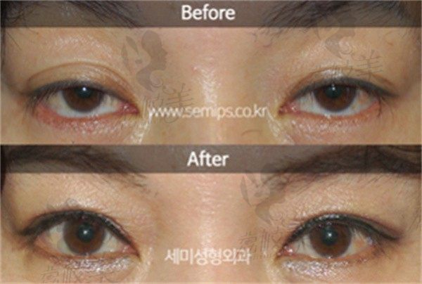 韩国世美双眼皮修复案例：和疤痕、眼窝凹陷及三白眼统统说拜拜