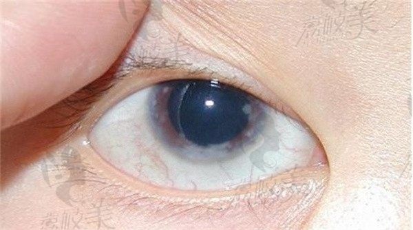 原发性开角型青光眼和继发性开角型青光眼的分类和症状区别