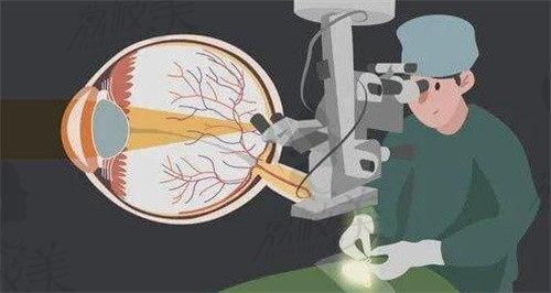 高考前做近视眼手术完全来得及,解答要提前多久做/什么时候可以做