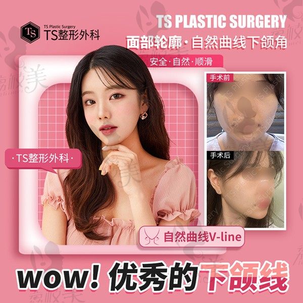 在韩国ts整形做自然曲线v-line下颌角手术分享，李相均打造气质公主脸