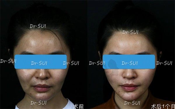 种草北京冰新丽格医院隋冰医生，技术巨好修复了我的馒化脸问题