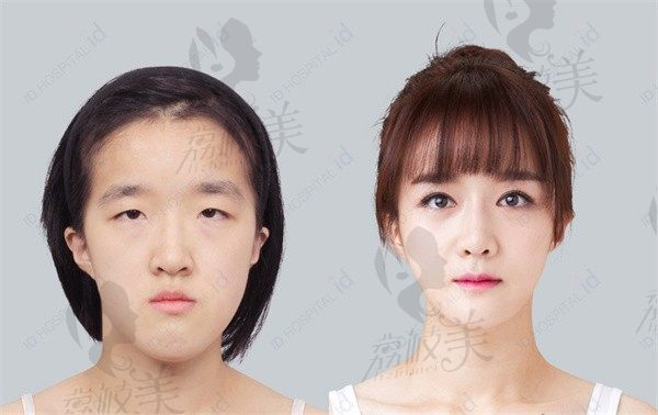 韩国id整形下巴女生手术图片惊艳，做完vline下颌角get明星同款脸