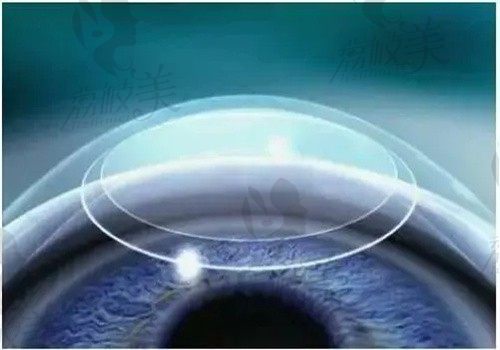 smart激光手术对角膜厚度有要求，角膜切除量、优缺点和手术后遗症一文解惑