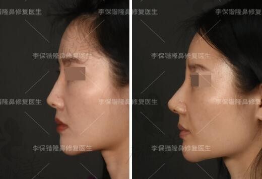 李保锴做鼻子很出名，在杭州清锴坐诊鼻整形及修复有案例分享价格6W起
