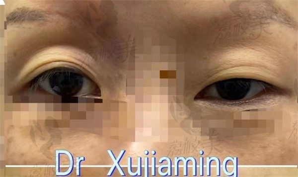 徐佳明医生做眼睛很厉害，从外地赶到西安叶子做手术后我很满意