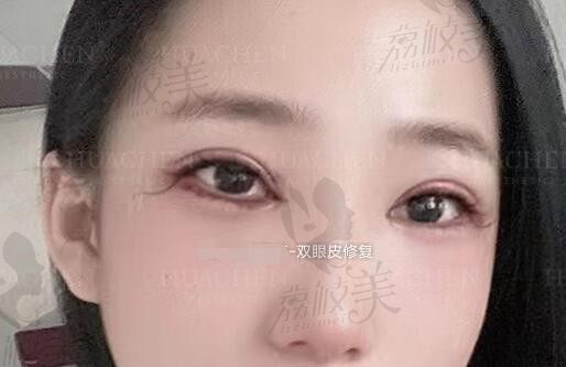 北京双眼皮修复推荐：北京双眼皮修复比较好的医生谁的价格便宜点?