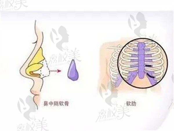 深圳美莱梁志为医生技术特别棒，用我的真实例子说明做的鼻子超自然