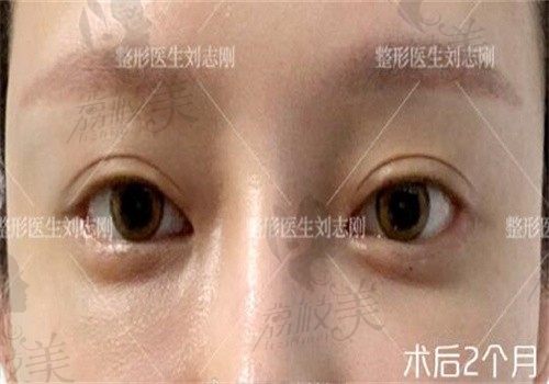 刘志刚双眼皮宽变窄修复手术价格22800元起，亲证结果好有案例