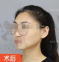 北京张笑天改脸型的技术很牛，我花8.5W价格做的颧骨+下颌角很自然