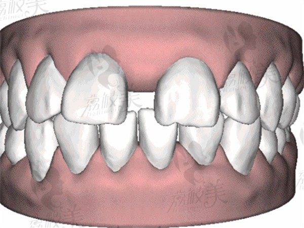 来谈谈门牙缝隙大是什么原因导致的？又要怎么治疗才能改善这个问题