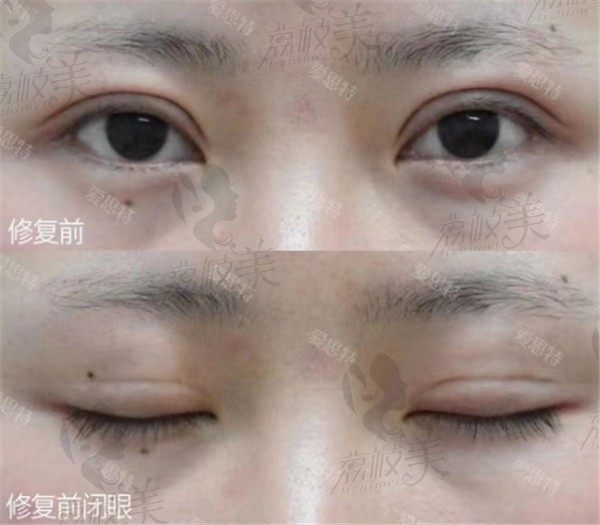 手术前