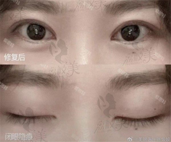 手术后