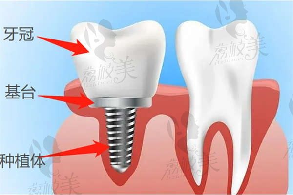 韩国科威尔种植牙价格6k起，适合人群|使用寿命|烤瓷冠选择看这篇了解