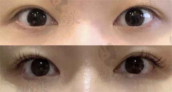 韩国伊美芝院长做双眼皮实力派，肿眼泡单眼皮消失术即刻呈现