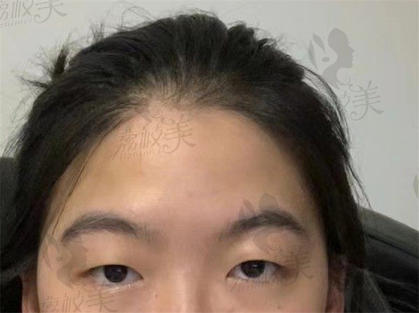 在此分享我找北京艺星王博谦割双眼皮案例，终于拥有自然无痕的双眼