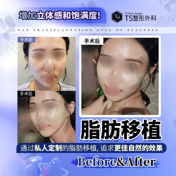 韩国ts脂肪移植面部私人定制方案，拯救面颊凹陷更显年轻态