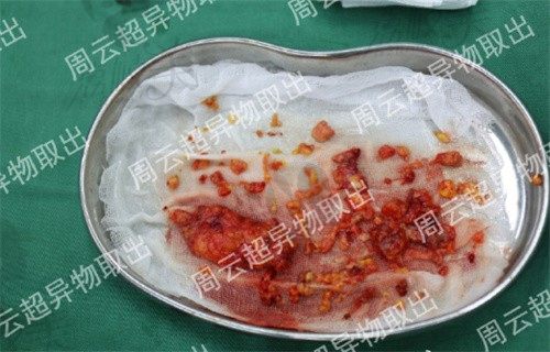 北京周云超医生做异物取出的案例图分享,含多种异物取出真实图片