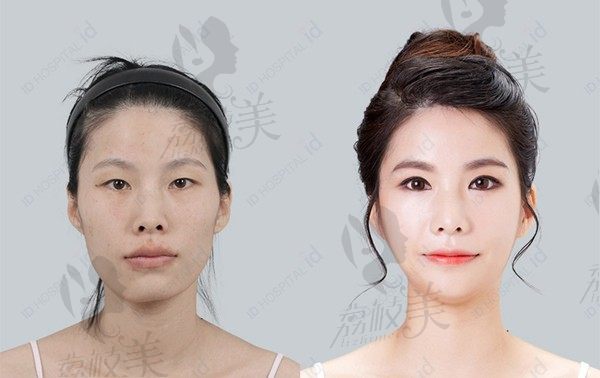 韩国id磨下颌角效果自然，从大饼脸到明星小v脸只需要一个李知赫
