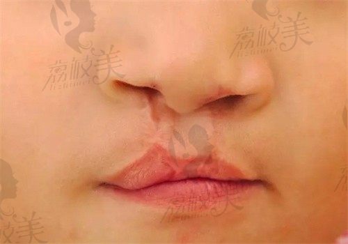 北京马群医生唇腭裂修复怎么样？续发性唇裂修复28000元起技术到位