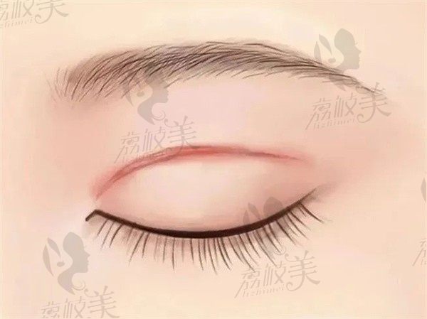 成都八大处祁峰医生做双眼皮怎么样？分享我的双眼皮案例真的超自然