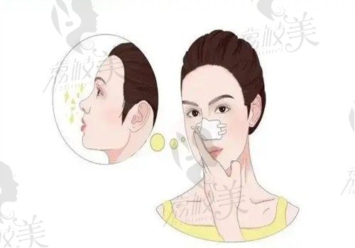 上海谢卫国隆鼻案例分享，做鼻子风格自然收费不贵