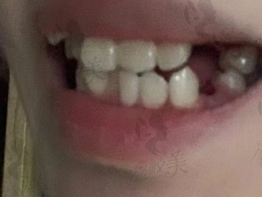 青岛优诺口腔医院牙齿矫正案例分享：通过矫正牙整齐了人也自信了