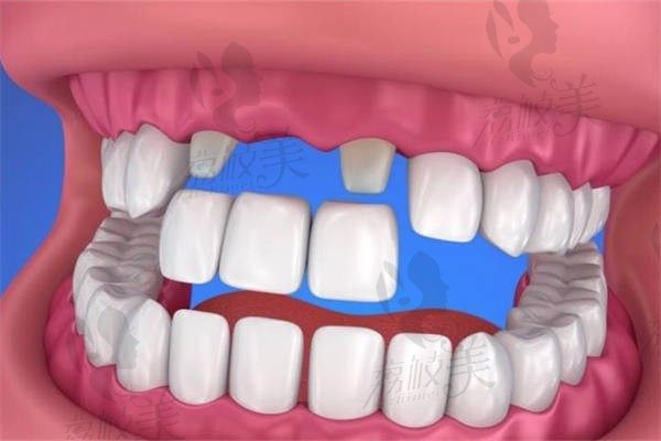 义齿修复和种植牙的区别：从修复方式/使用寿命/优缺点分析