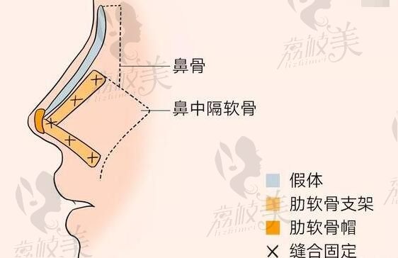 是的，刘彦军在北京沃尔医院，擅长做鼻子价格是7W+风格为定制