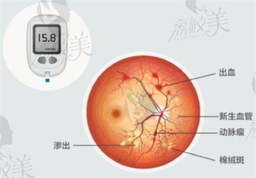 广州黄埔爱尔眼科视网膜手术李永浩主诊,糖尿病视网膜病变治疗2w起