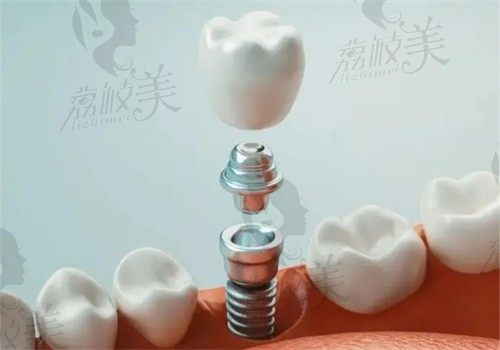 长沙牙安亲口腔种植牙技术先进，高端瑞士ITI植体9800起术前可视