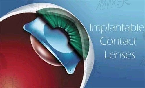 成都佰视佳眼科做近视手术很有名，ICL晶体植入26800起院长赵小虎亲诊