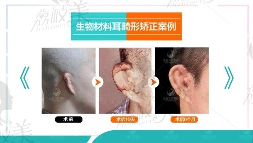 北京丽都医院能做耳朵手术,尤其是安波博士耳再造价格6w元起
