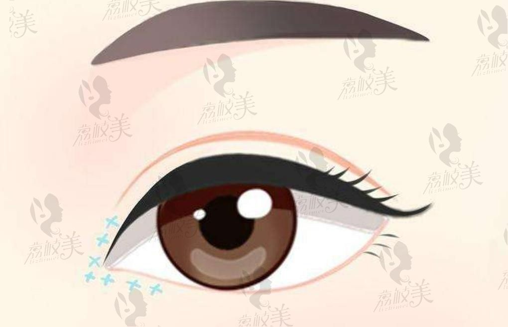 杭州艺星杨连华双眼皮案例分享，给我做了美杜莎眼综合疤痕不明显超自然