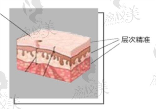 王荣锡吸脂案例分享，花1万多做的腰腹环吸小腹很平整